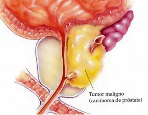 Prostalinex precio